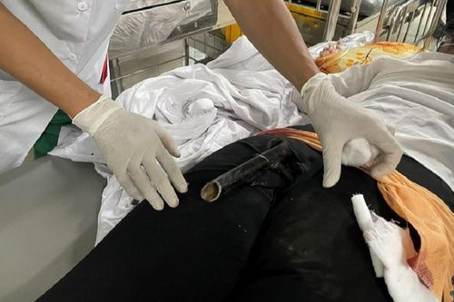 Cấp cứu thành công cô gái bị chân chống xe máy đâm vào mông sau va chạm giao thông
