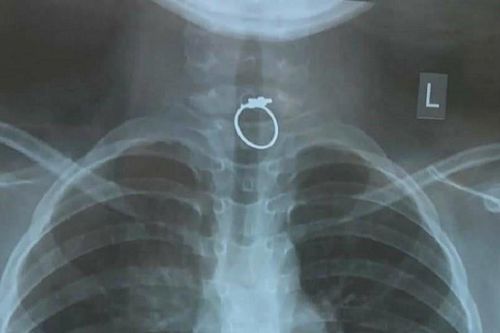 Bé gái 3 tuổi nghẹn và khóc nấc liên tục vì nuốt phải chiếc nhẫn
