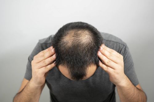 Phát hiện mới về cách chữa hói đầu cho nam giới