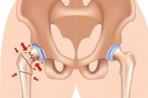 Tăng nguy cơ gãy xương hông sớm ở phụ nữ béo phì