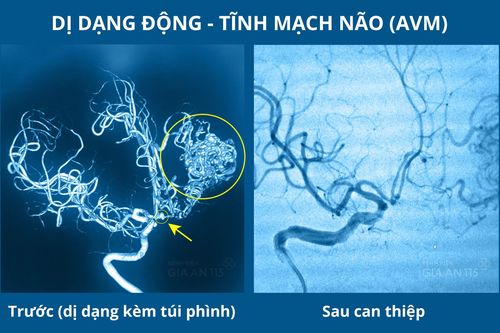 Nhập viện vì đau đầu, buồn nôn, không ngờ bị đột quỵ do xuất huyết não
