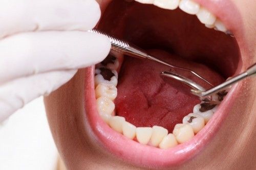 7 cách chữa sâu răng tại nhà hiệu quả