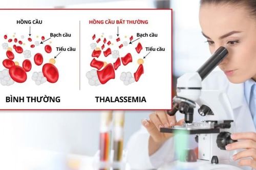 Những dấu hiệu cảnh báo bệnh tan máu bẩm sinh