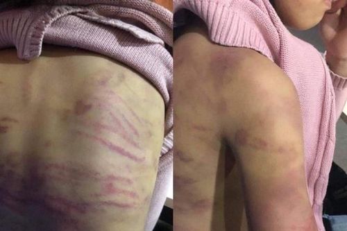 Hà Nội: Điều tra vụ bé gái 12 tuổi bị mẹ đẻ và 'người tình' bạo hành
