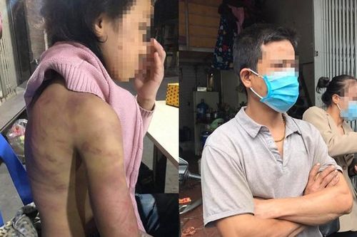 Bé gái 12 tuổi nghi bị mẹ ruột bạo hành, người tình của mẹ xâm hại nhiều lần