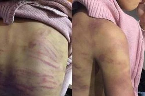 Bé gái 12 tuổi nghi bị bạo hành, xâm hại tình dục: Cục Trẻ em lên tiếng
