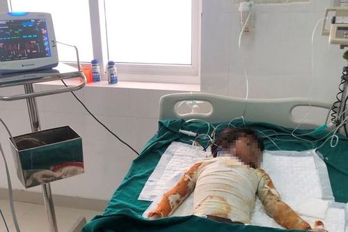 Đốt rác ngày đầu năm, cháu bé 7 tuổi bị bỏng nặng