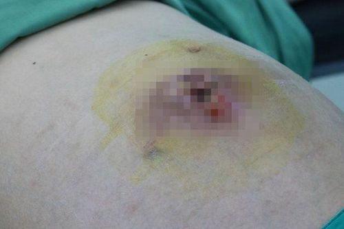 Cô gái trẻ mất cơ hội làm mẹ sau khi chữa u xơ tại phòng khám tư
