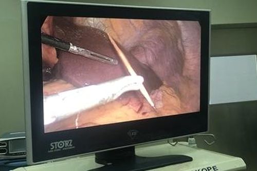 Nằm võng nuốt phải tăm tre, người đàn ông thủng dạ dày