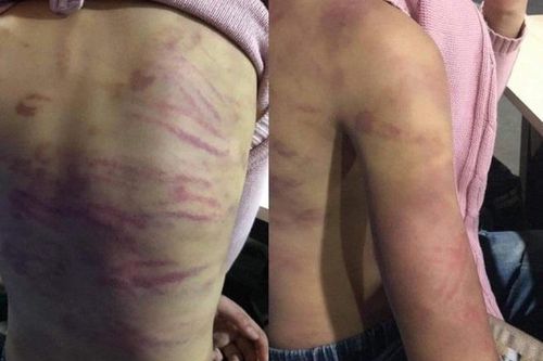Bé gái nghi bị bạo hành, xâm hại: 'Bố không nhận nuôi, con sẽ vào trại mồ côi'