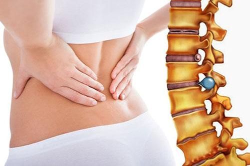 Tất cả những gì bạn cần biết về bệnh thoát vị đĩa đệm