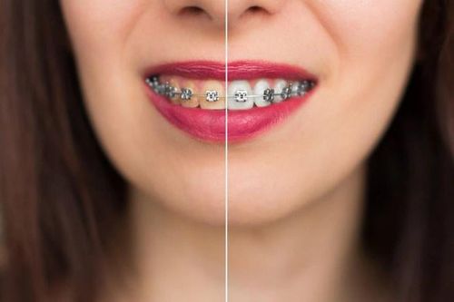 5 thói quen xấu gây hại cho răng
