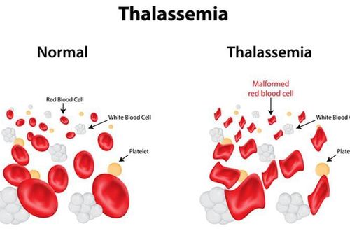Nguy cơ mắc Thalassemia do thiếu máu, thừa sắt