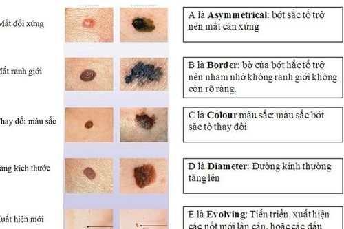 Nhận biết ung thư da qua bớt sắc tố