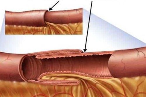 Người lớn cũng có thể bị lồng ruột
