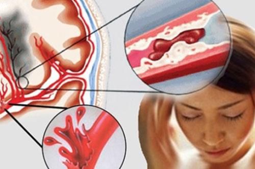 Dấu hiệu cảnh báo mạch máu bị tắc nghẽn