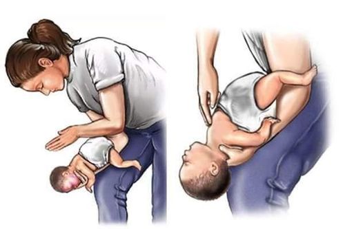 Xử lý thế nào khi trẻ tắc dị vật đường thở?