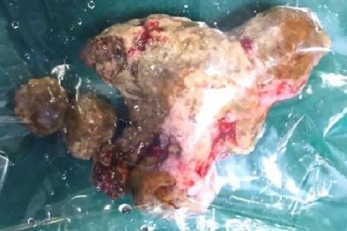Sốc nhiễm khuẩn do ứ mủ thận vì tự dùng thuốc nam điều trị sỏi thận