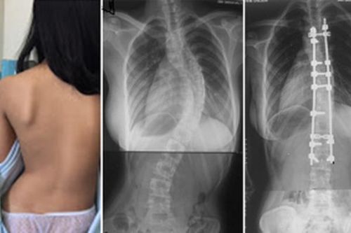 Cảnh giác với cong vẹo cột sống ở trẻ