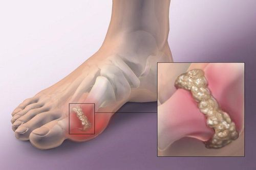 Cảnh giác với bệnh gút sau Tết