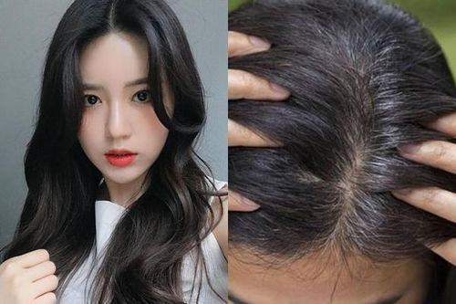 Vì sao ngày càng nhiều người trẻ bị bạc tóc?