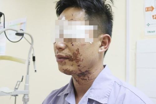 Nổ bình ga khi ăn lẩu người đàn ông bỏng vùng mặt