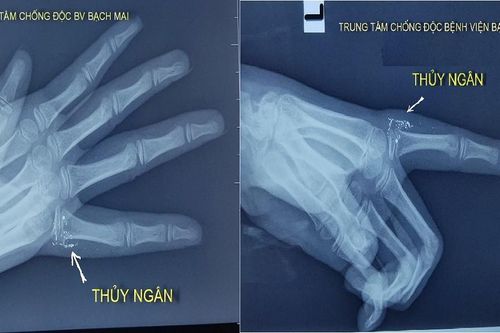 Sơ ý làm vỡ nhiệt kế, bé gái 11 tuổi bị nhiễm độc thủy ngân