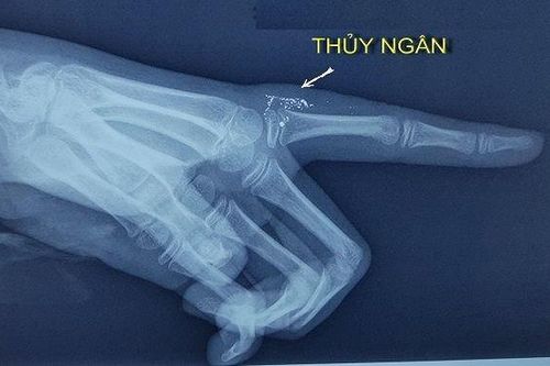 Bé gái 11 tuổi bị nhiễm độc thủy ngân do vỡ nhiệt kế