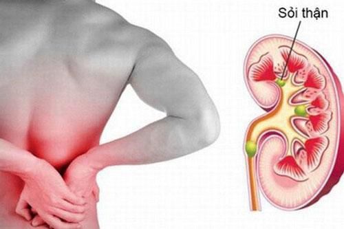 Dấu hiệu cảnh báo thận đang có sỏi