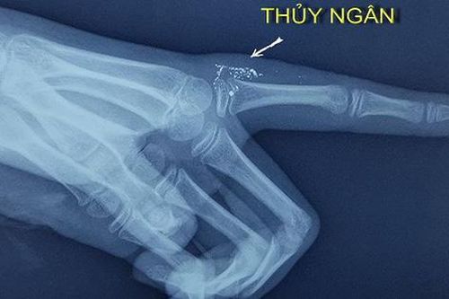 Bệnh nhi bị nhiễm độc thủy ngân do nhiệt kế đâm vào tay