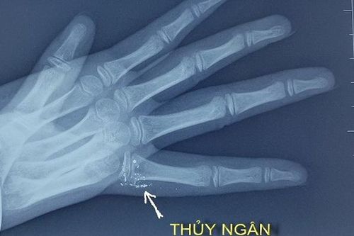 Trẻ 11 tuổi nhiễm độc thủy ngân do vỡ nhiệt kế