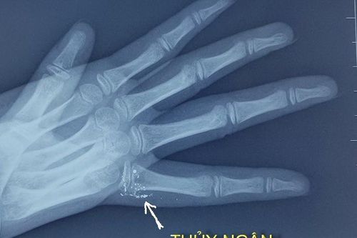 Trẻ bị nhiễm độc thủy ngân vì vỡ nhiệt kế