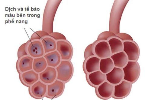 Bài thuốc hỗ trợ trị nhiễm trùng ở phổi
