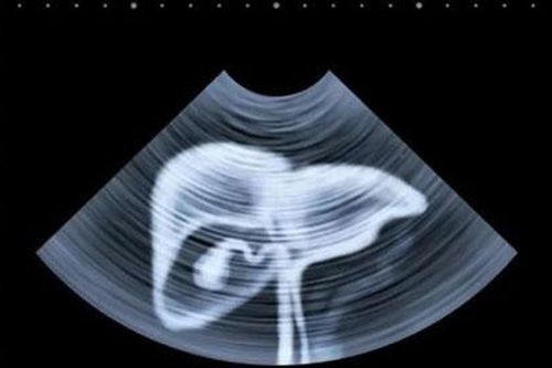 Chuyên gia chỉ điểm 5 kiểu người dễ ung thư gan, bạn có trong số đó?