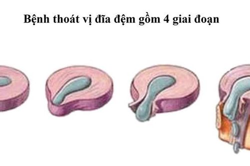 Đau lưng - thận trọng với phình đĩa đệm cột sống