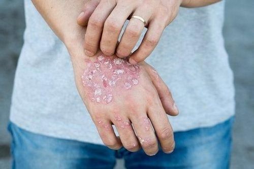 Những điều cần làm khi mắc chàm