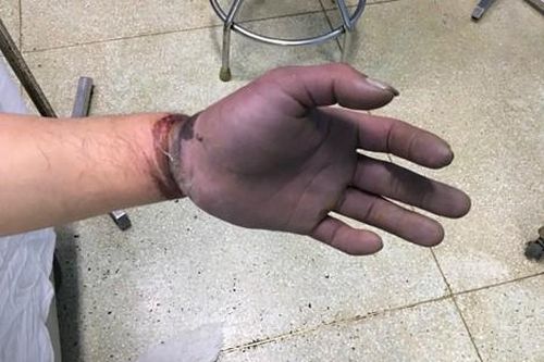 Tai nạn lao động khiến nam thanh niên suýt mất chức nặng vận động tay