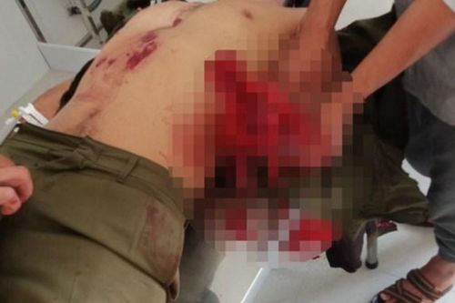 7 người bị thương do mìn đánh cá tự chế phát nổ