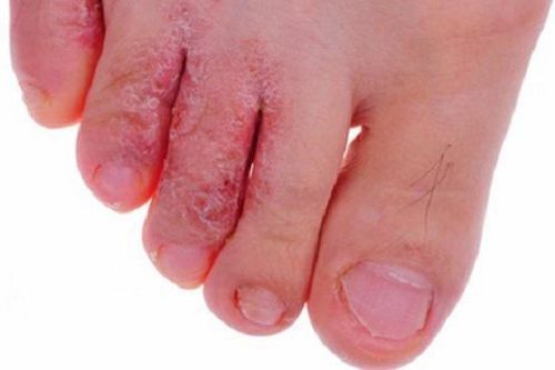 Trời nồm ẩm, cẩn thận bệnh nấm da