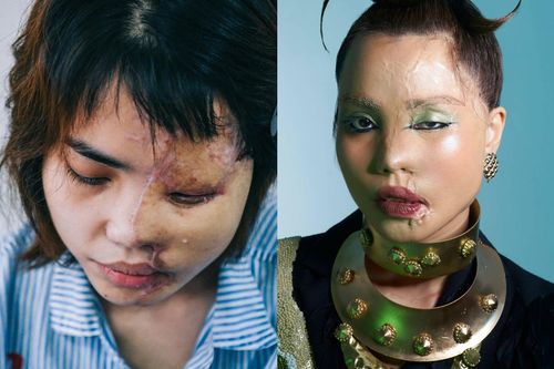 Cô gái bị tạt axit xuất hiện trong bộ ảnh nghệ thuật