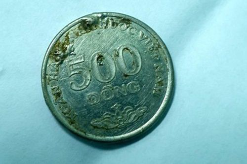 Cứu bé gái bị đồng xu vướng ở thực quản