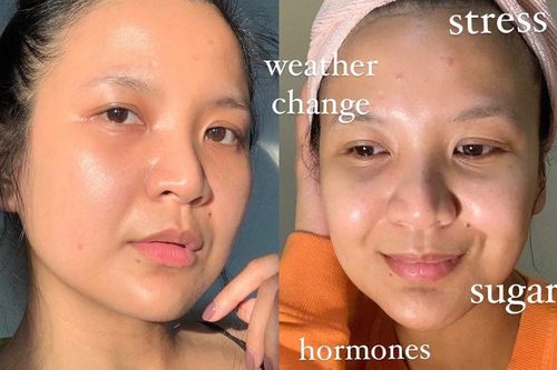6 thói quen khiến da bạn ngày càng xuống dốc