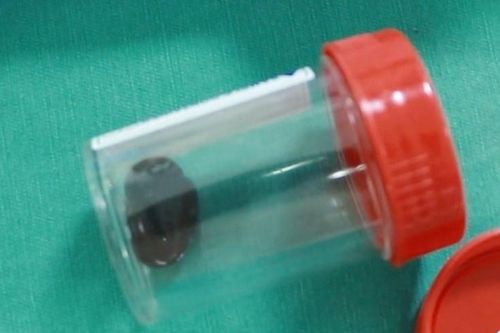 Người đàn ông bị ho ra máu do vắt chui vào khí quản