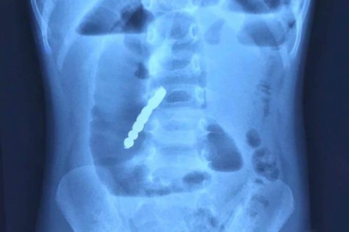 Cứu bé gái hai tuổi bị thủng ruột do nuốt phải bi nam châm đồ chơi