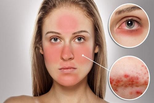 Cách xử lý cấp tốc khi bị dị ứng mỹ phẩm