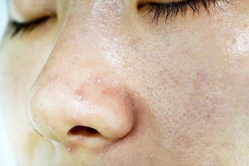 Da dầu nổi mụn, phải làm gì?