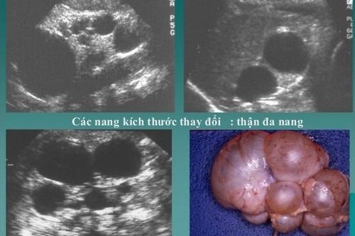 Bệnh thận đa nang có nguy hiểm?