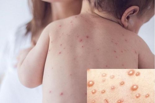 Sai lầm dễ gặp khi dùng thuốc trị thủy đậu