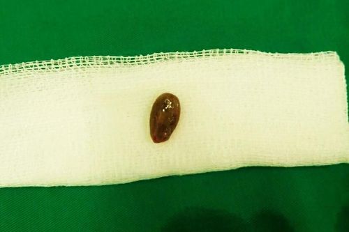Hạt dưa nằm trong phổi bé gái 18 tháng tuổi