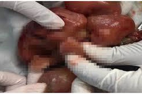 Phẫu thuật cho bé gái 1 ngày tuổi nghi thai trong thai cực hiếm gặp